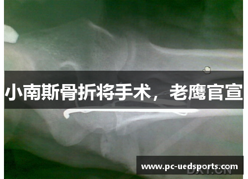 小南斯骨折将手术，老鹰官宣